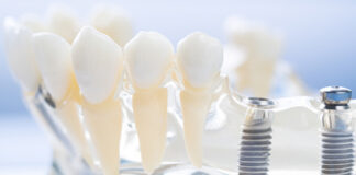 Dental Implants Made in Australia: Proudly Home Grown Australian-made dental implants