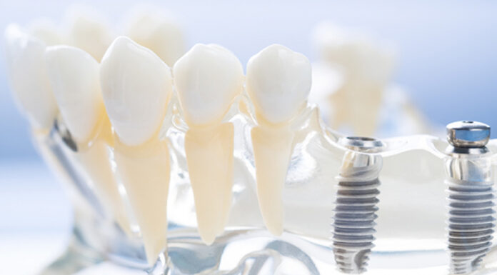 Dental Implants Made in Australia: Proudly Home Grown Australian-made dental implants