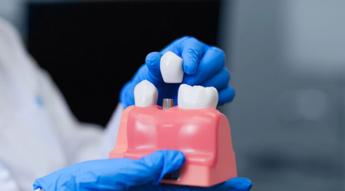Are Dental Implants Right for You? Understanding the Procedure and Benefits dental implant