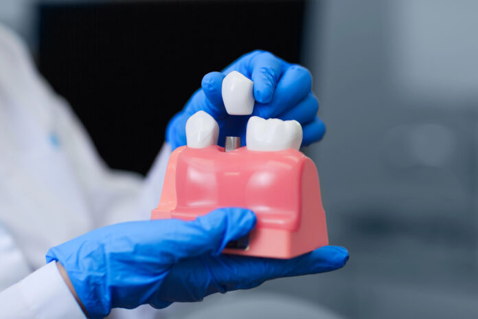 dental implant dental implant